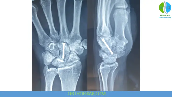 Capitate Fracture treatment