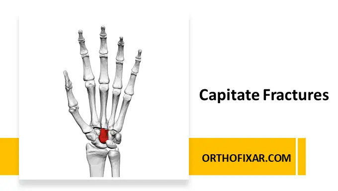 Capitate Fracture