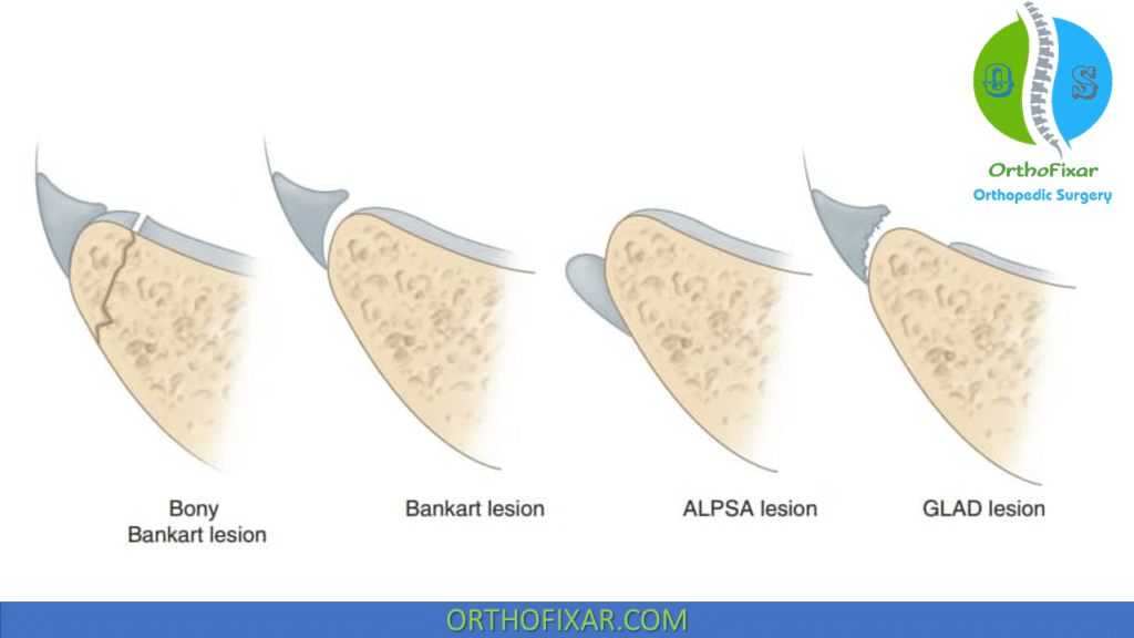 Capsulolabral lesions types