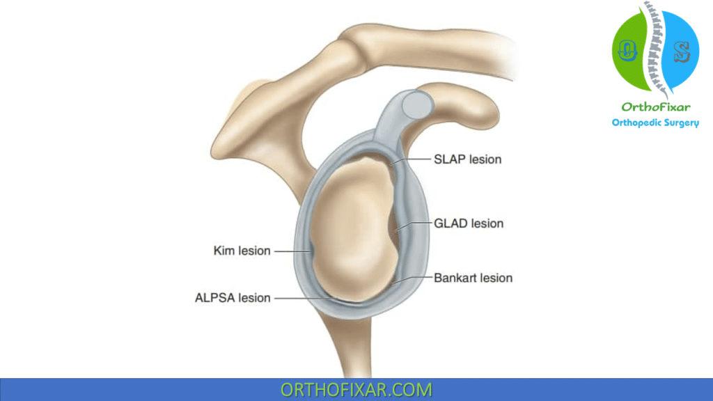 Capsulolabral lesions types