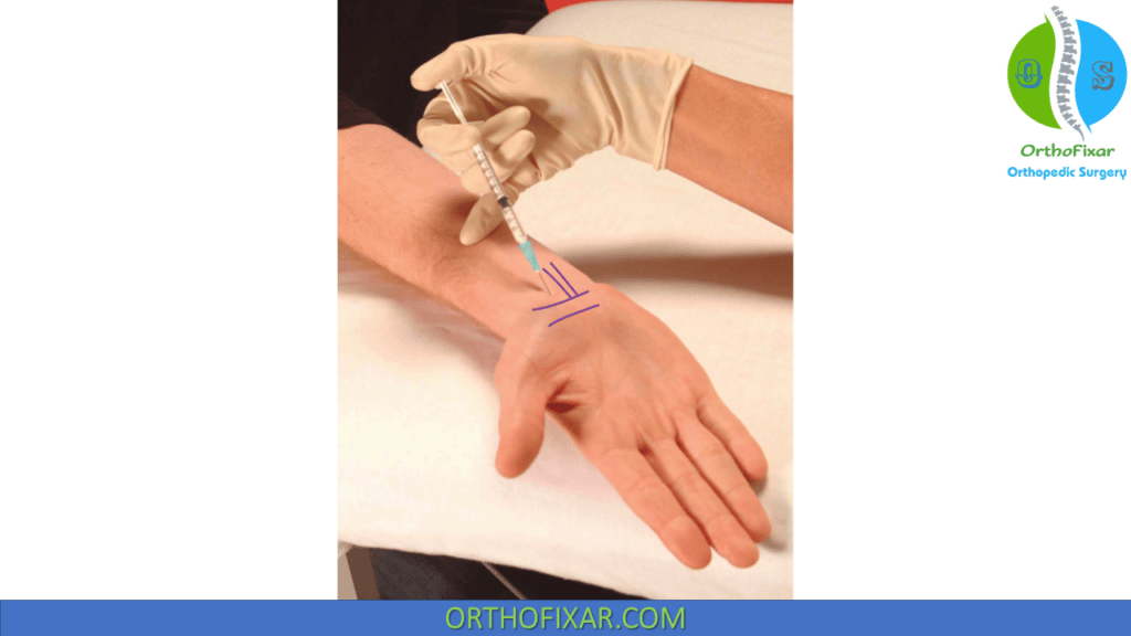 Carpal Tunnel Injection Technique