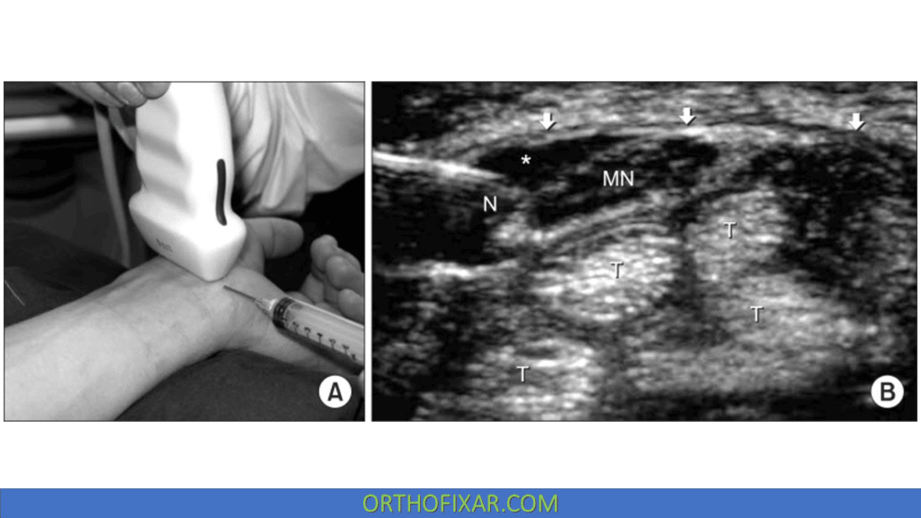 Carpal Tunnel Injection Ultrasound