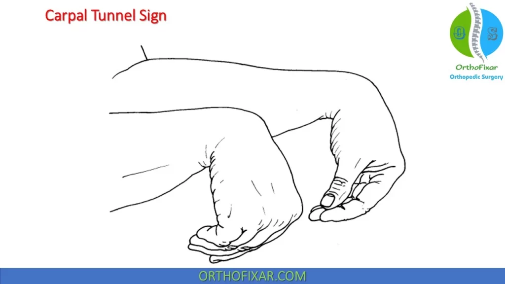 Carpal Tunnel Sign