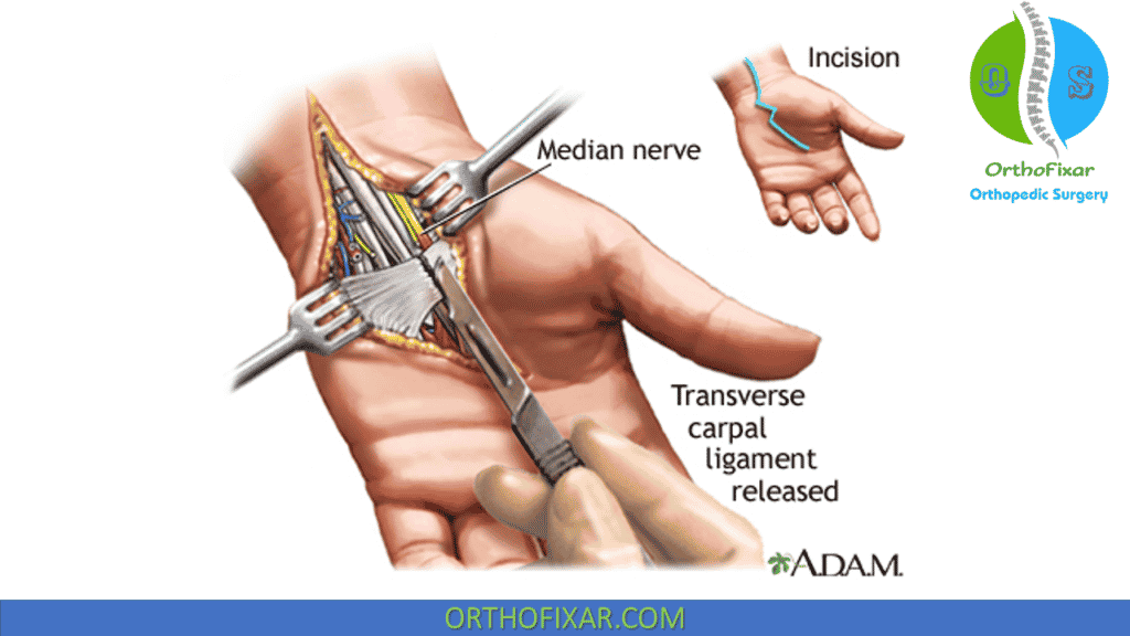 Carpal Tunnel Surgery Release