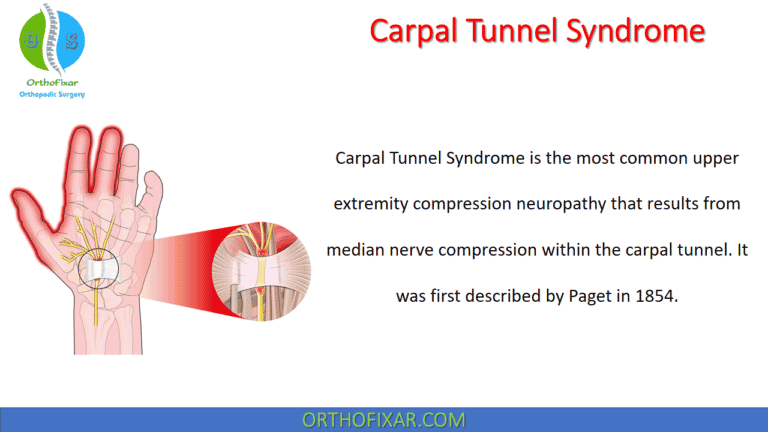 Carpal Tunnel Syndrome