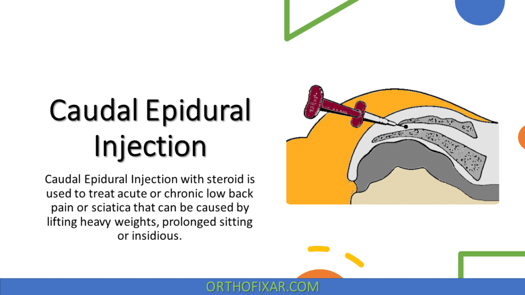 Caudal Epidural Injection Overview | OrthoFixar 2025