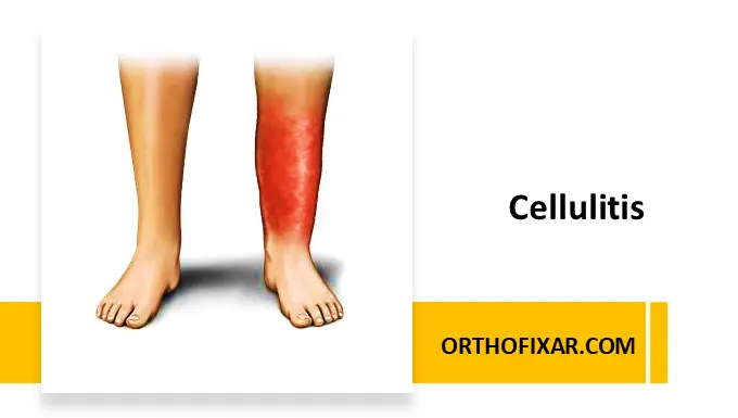 Cellulitis