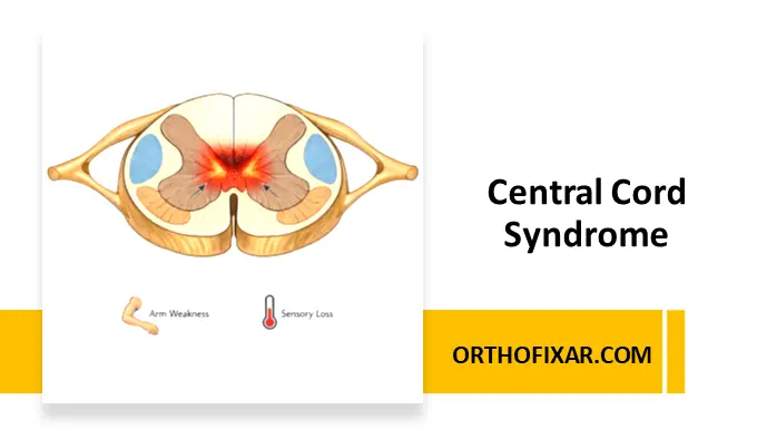 Central Cord Syndrome