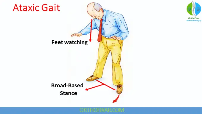 Ataxic Gait Definition 2 Cerebellar Ataxic Gait