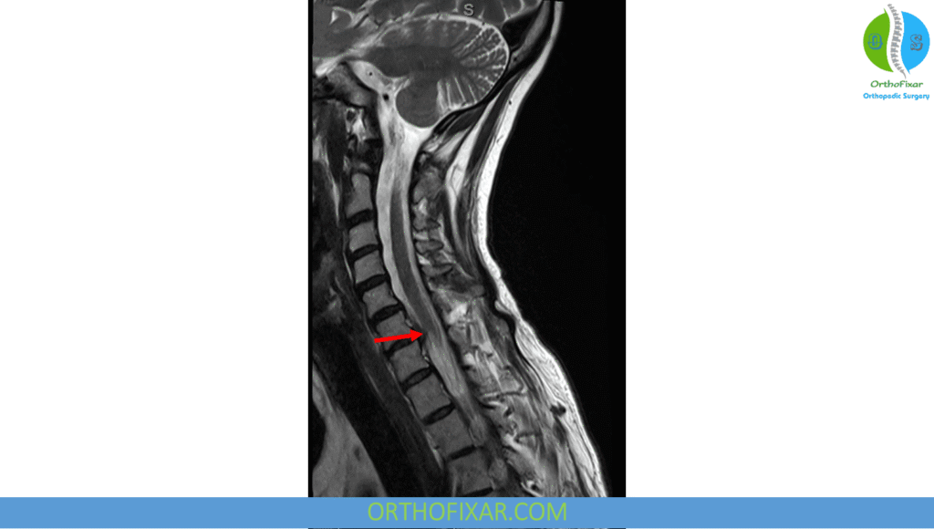Cervical Radiculopathy: Pinched Nerve Symptoms & Treatment 5 Cervical Radiculopathy mri