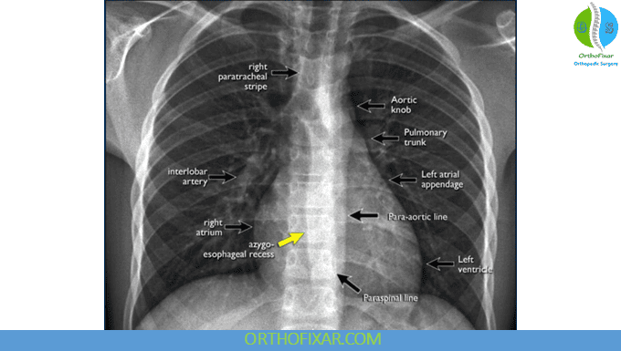Chest X-Ray Interpretation: A Systematic Student Approach 9 Chest X-Ray Interpretation
