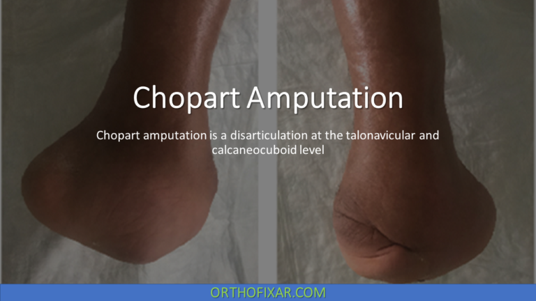 Chopart Amputation