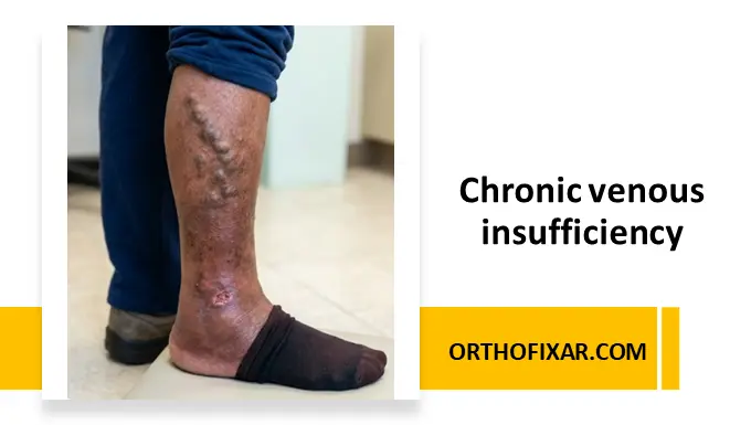 Chronic venous insufficiency (CVI)