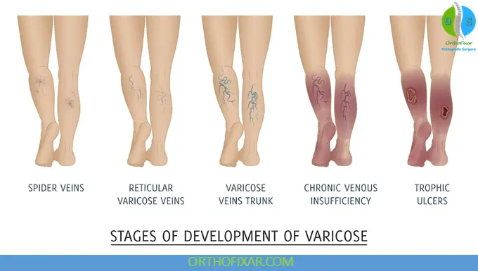 Chronic Venous Insufficiency (CVI) 5 Chronic venous insufficiency staging