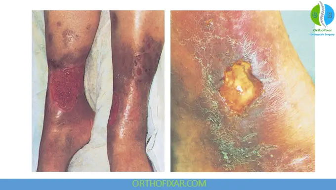 Chronic Venous Insufficiency (CVI) 6 Chronic venous insufficiency ulcers