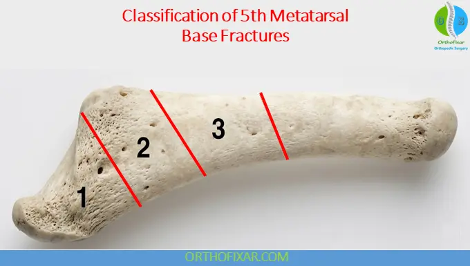 Classification of 5th Metatarsal Base Fractures zones