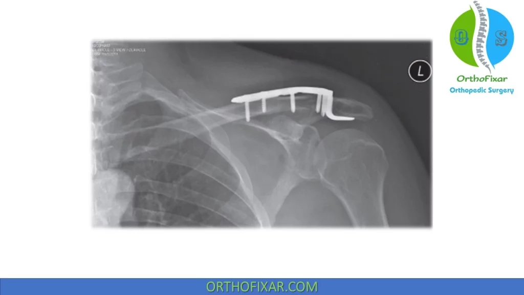 Clavicle Fractures treatment with hook plate