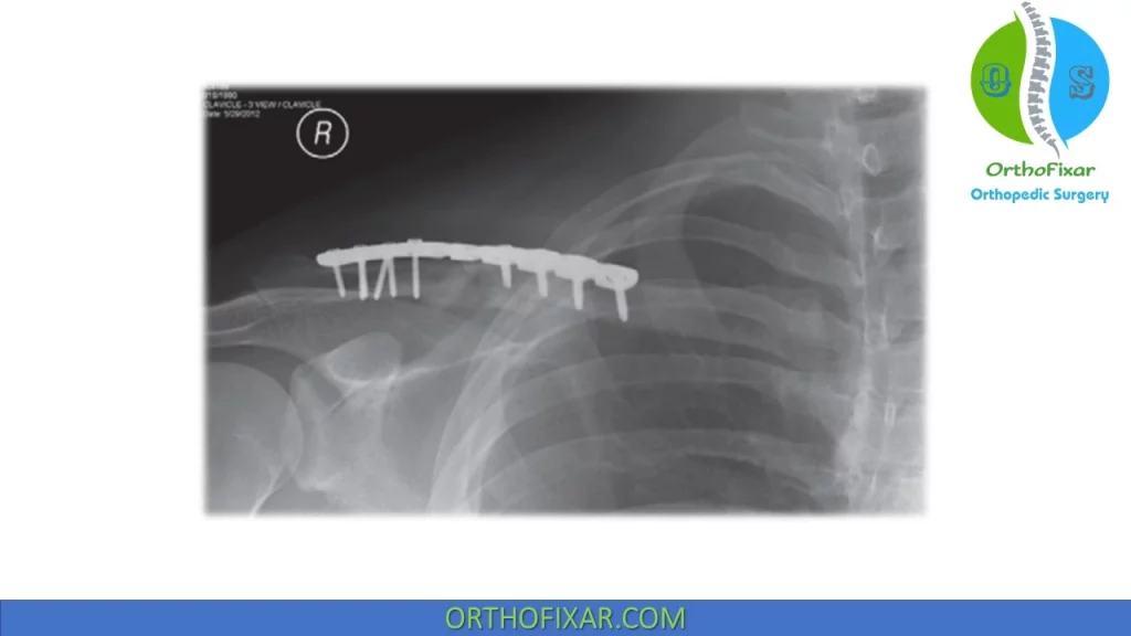 Clavicle Fractures treatment -superior plating