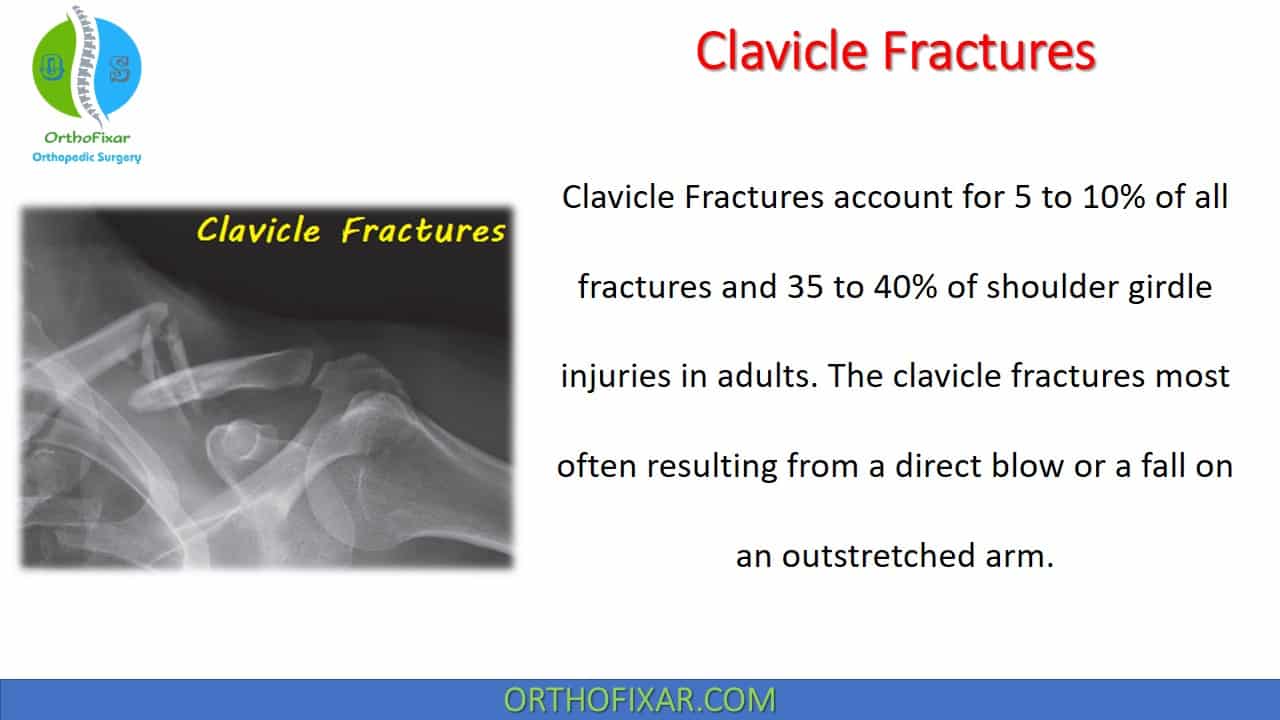  Clavicle Fractures 