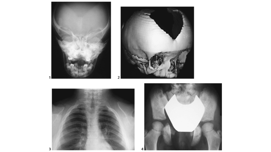 Cleidocranial Dysplasia: Causes, Symptoms & Treatment 5 Cleidocranial Dysplasia imagimg