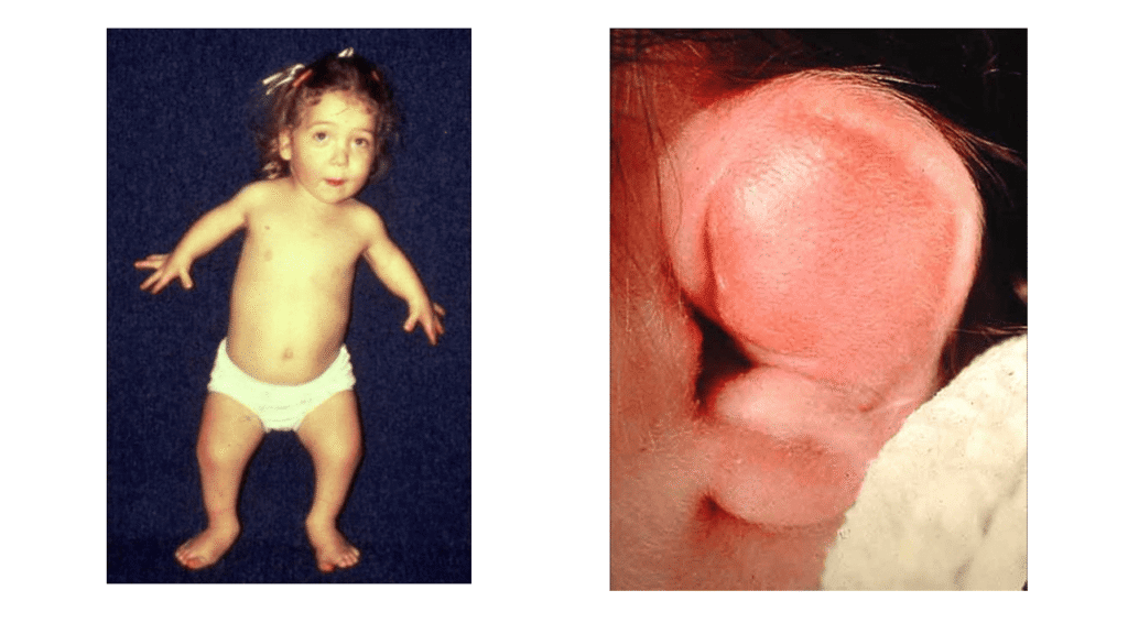 Clinical Features of Diastrophic Dysplasia