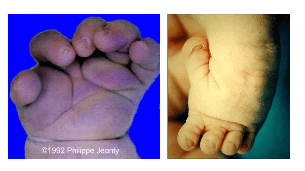 Clinical Features of Diastrophic Dysplasia foot and hand