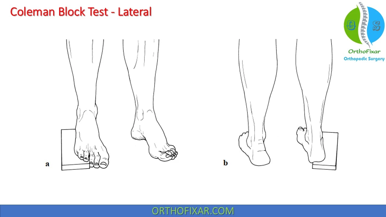 Coleman Block Test - lateral