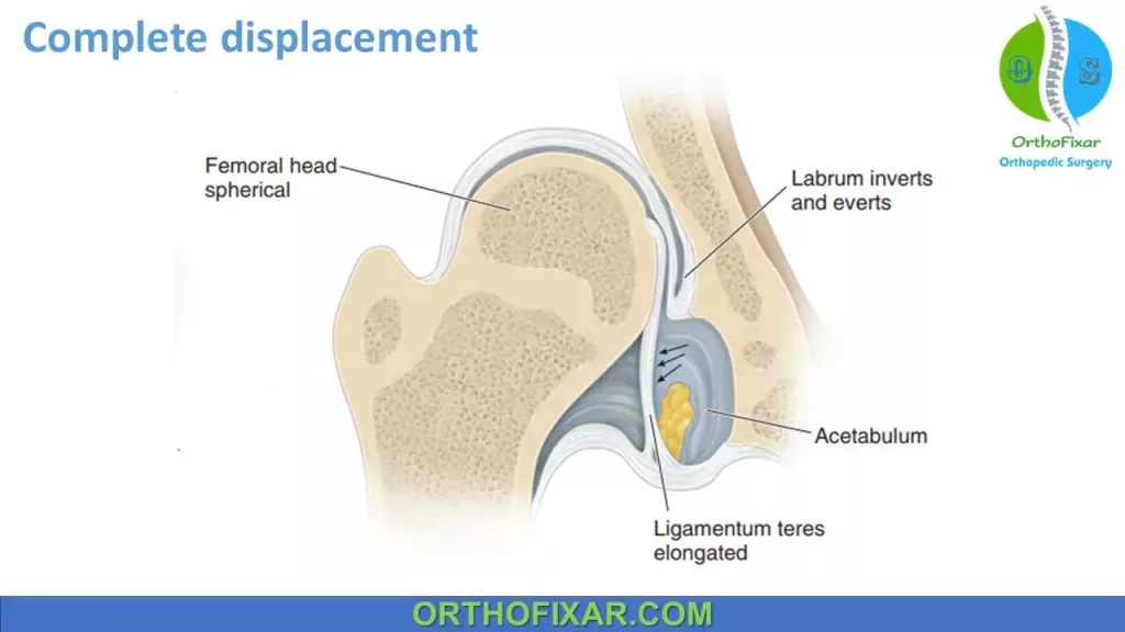 Complete displacement of the femoral head