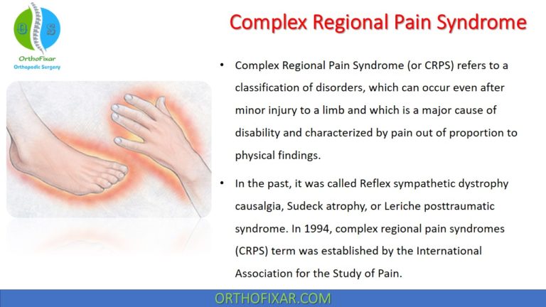 Complex Regional Pain Syndrome