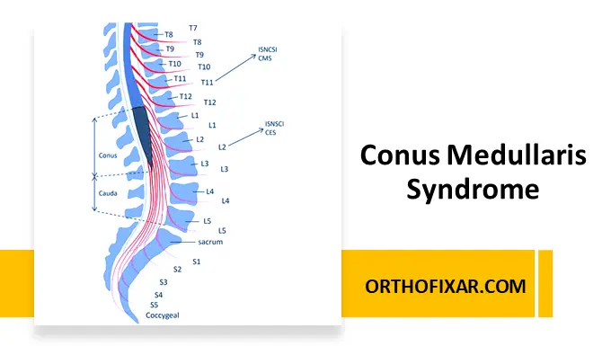 Conus Medullaris Syndrome
