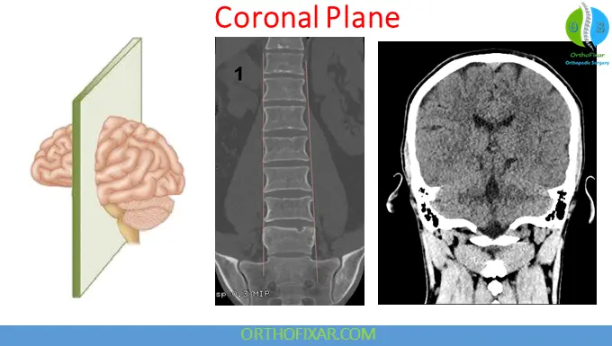 Coronal Plane
