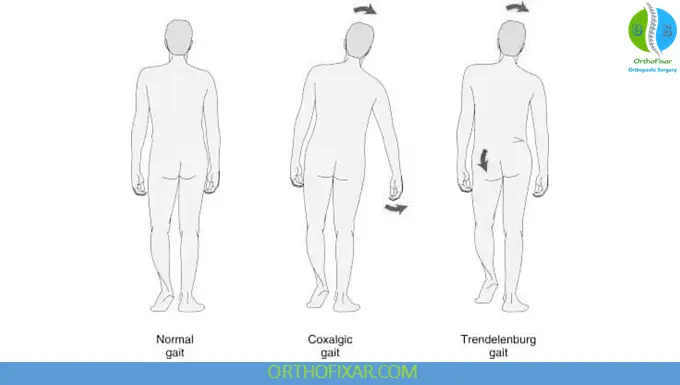 Coxalgic Gait vs. Trendelenburg Gait