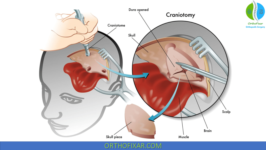 Craniectomy