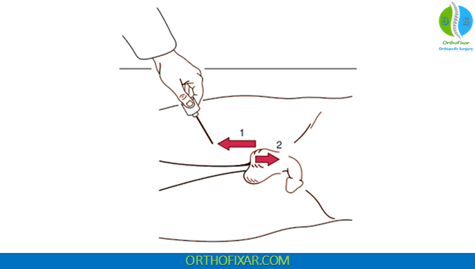 Cremasteric Reflex 2 Cremasteric Reflex test
