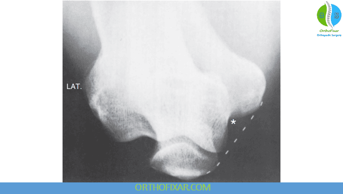 Elbow X-ray Views 3 Cubital Tunnel View