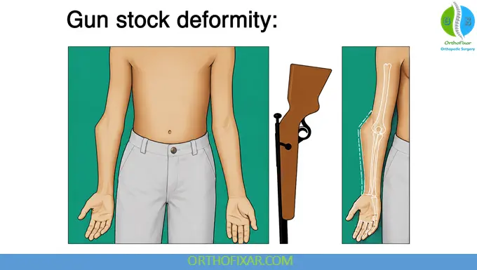 Cubitus Varus - Gunstock Deformity