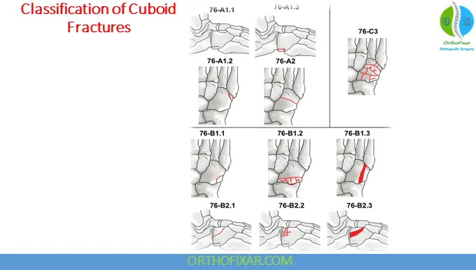 Cuboid Fractures classification