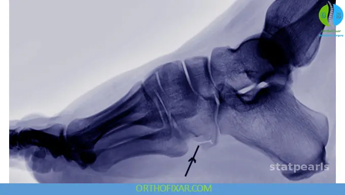 Cuboid Fractures xray