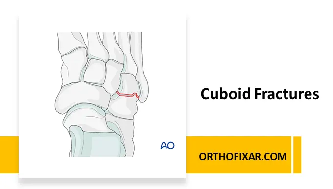 Cuboid Fractures