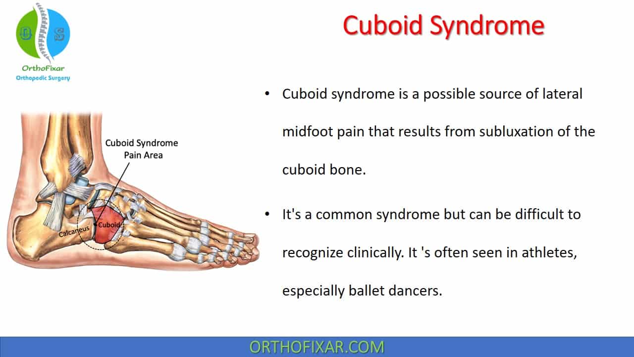  Cuboid Syndrome 