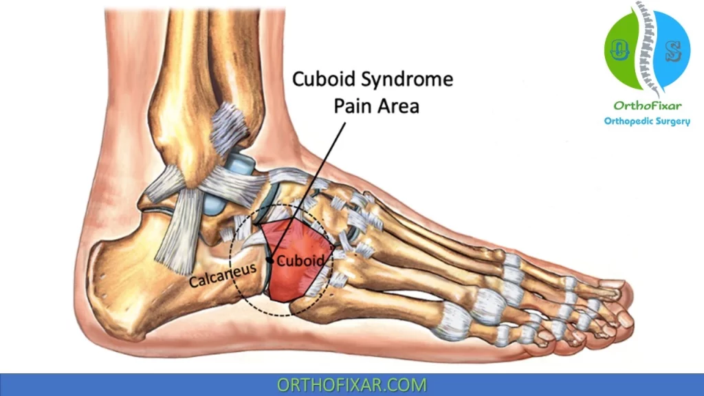 Cuboid Syndrome pain site