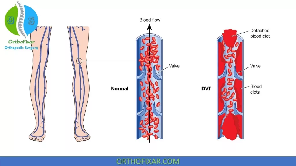 Deep venous thrombosis (DVT)