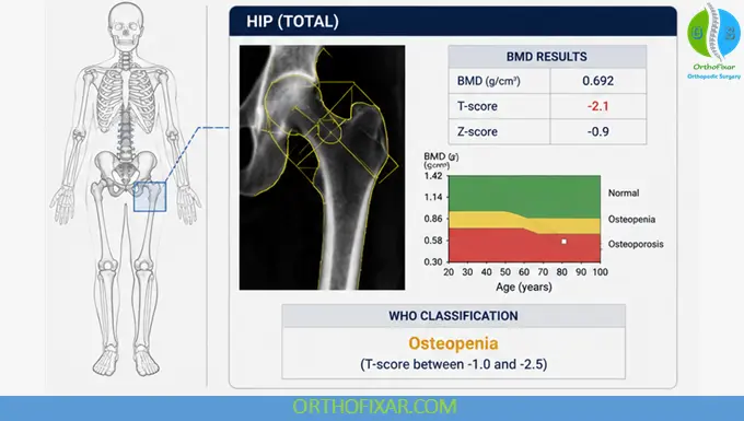 DXA scan hip