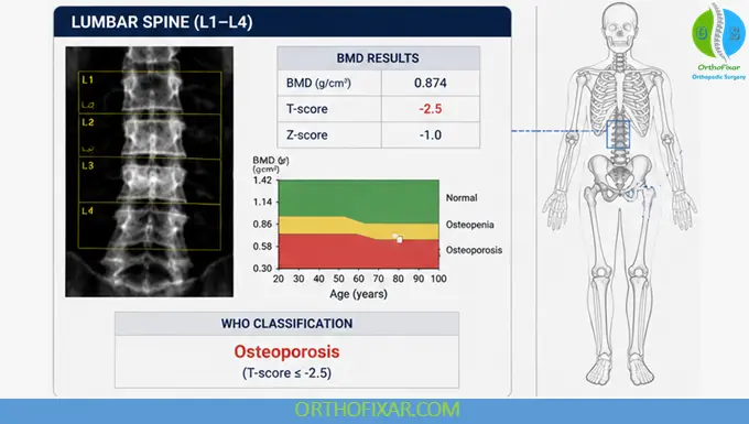 DXA scan spine