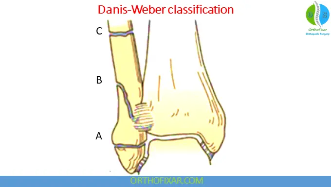 Danis-Weber Classification - Ankle Fractures