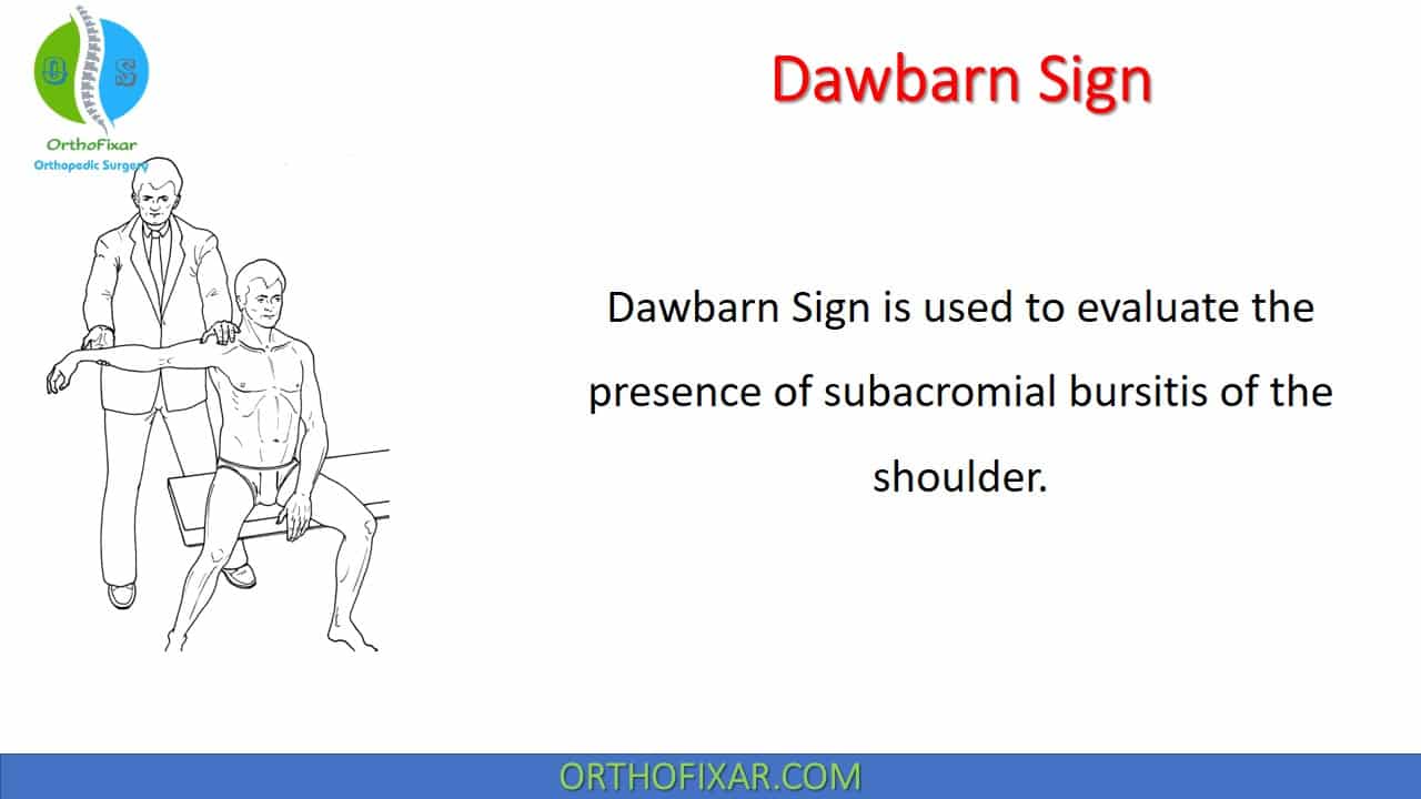  Dawbarn Sign for Subacromial Bursitis 