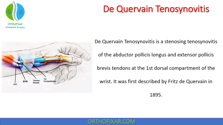De Quervain Tenosynovitis