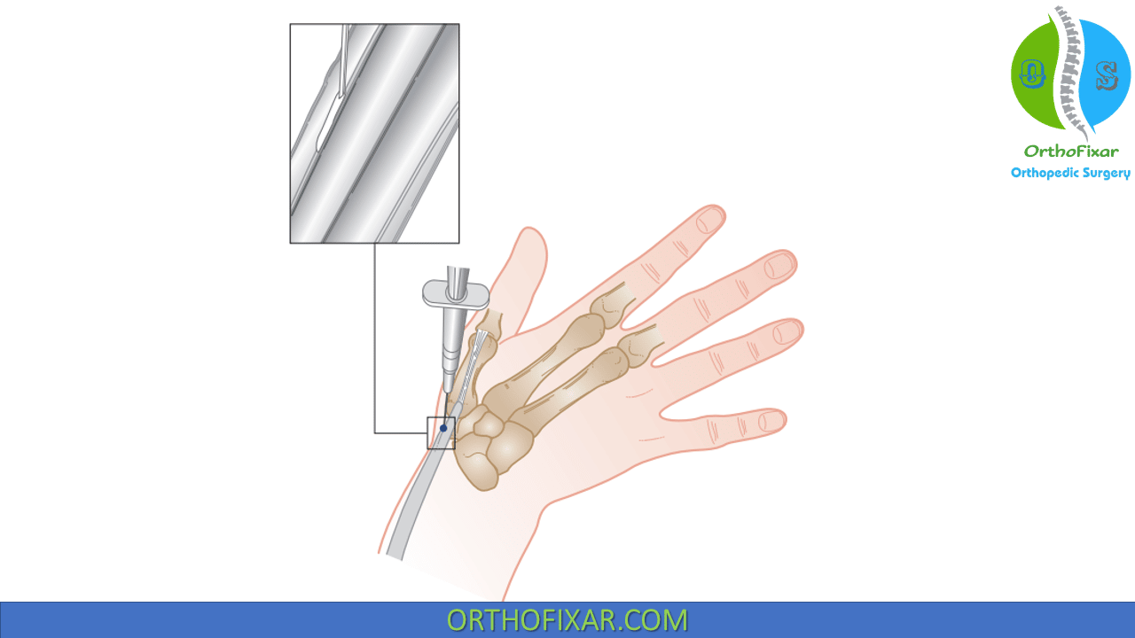 De Quervains Injection Orthofixar 2024 6503