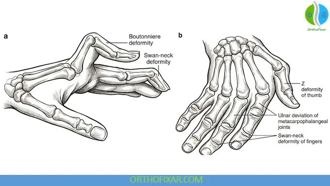 Rheumatoid Arthritis (RA): Causes, Symptoms, Diagnosis & Treatment 6 Deformities in Rheumatoid Arthritis