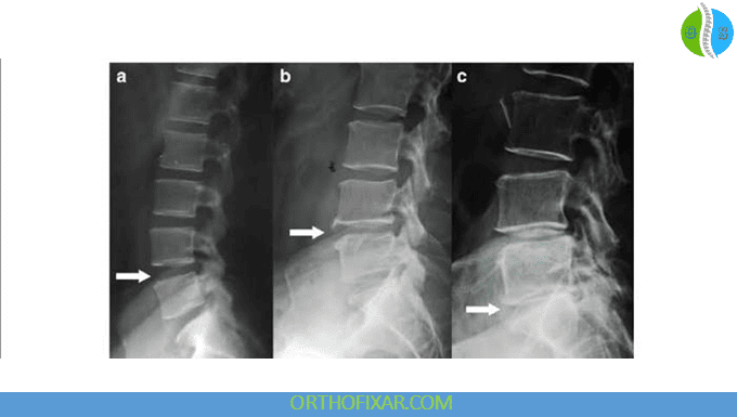 Degenerative Disc Disease xray